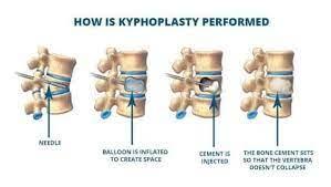 Vertebroplasty and Kyphoplasty